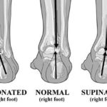 Što je pronacija? pronacija